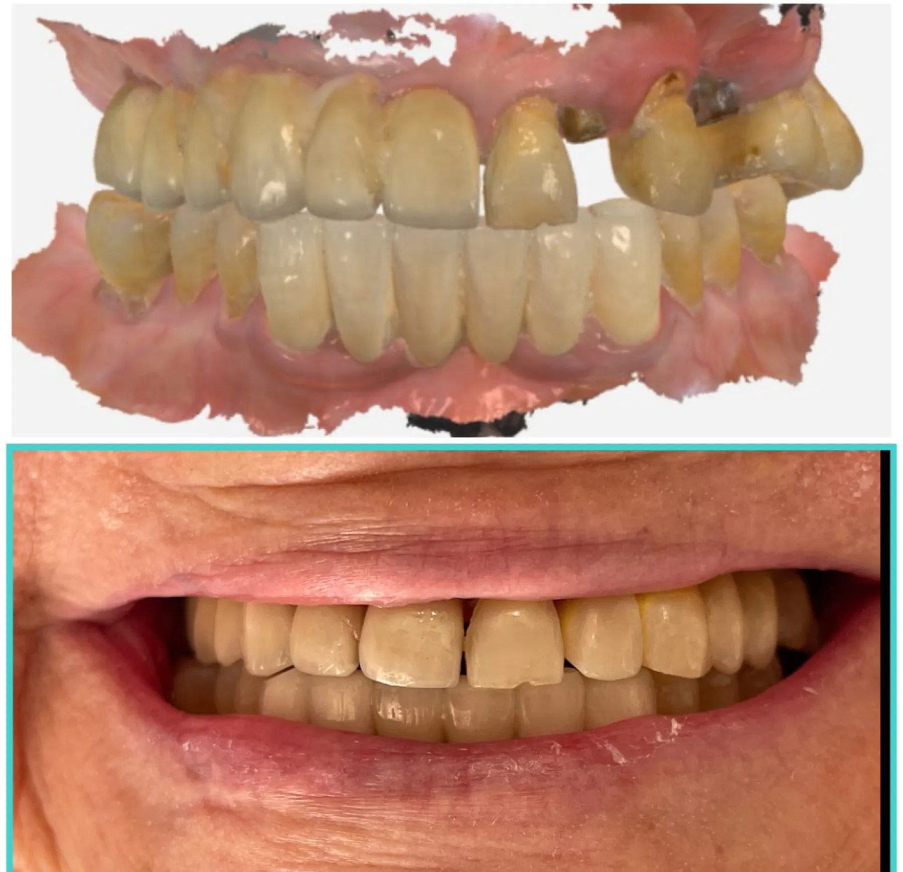 Zirconia Crowns Over Implants in the Anterior Zone