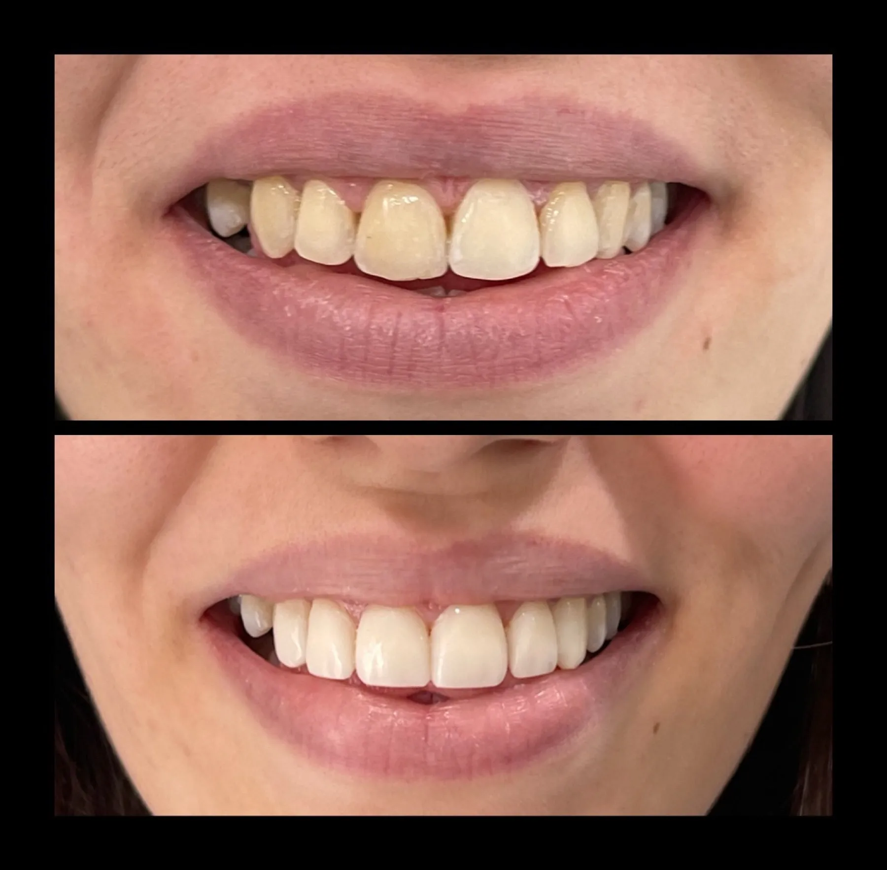 Composite Smile Makeover