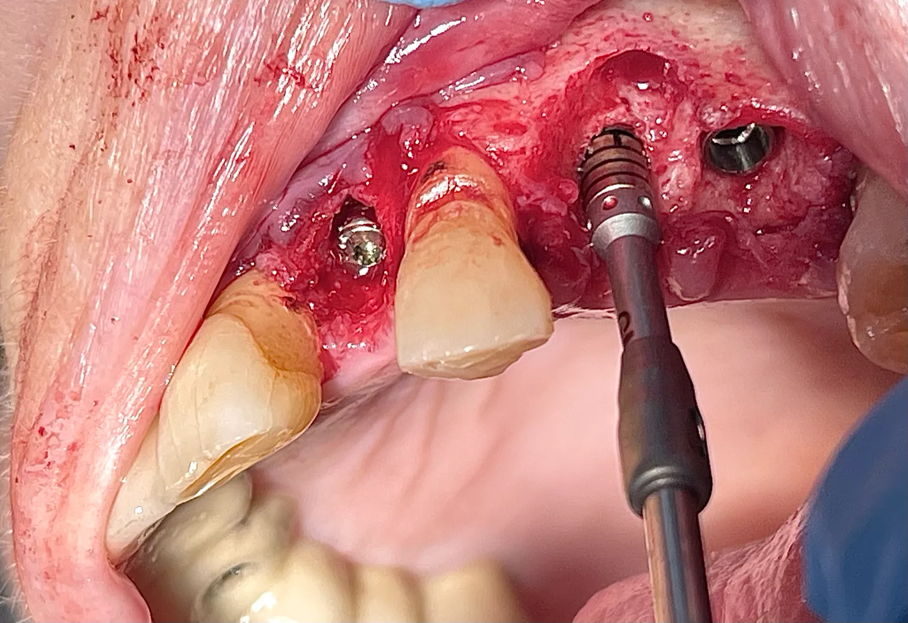 Freehand Implant Placement in the Aesthetic Zone
