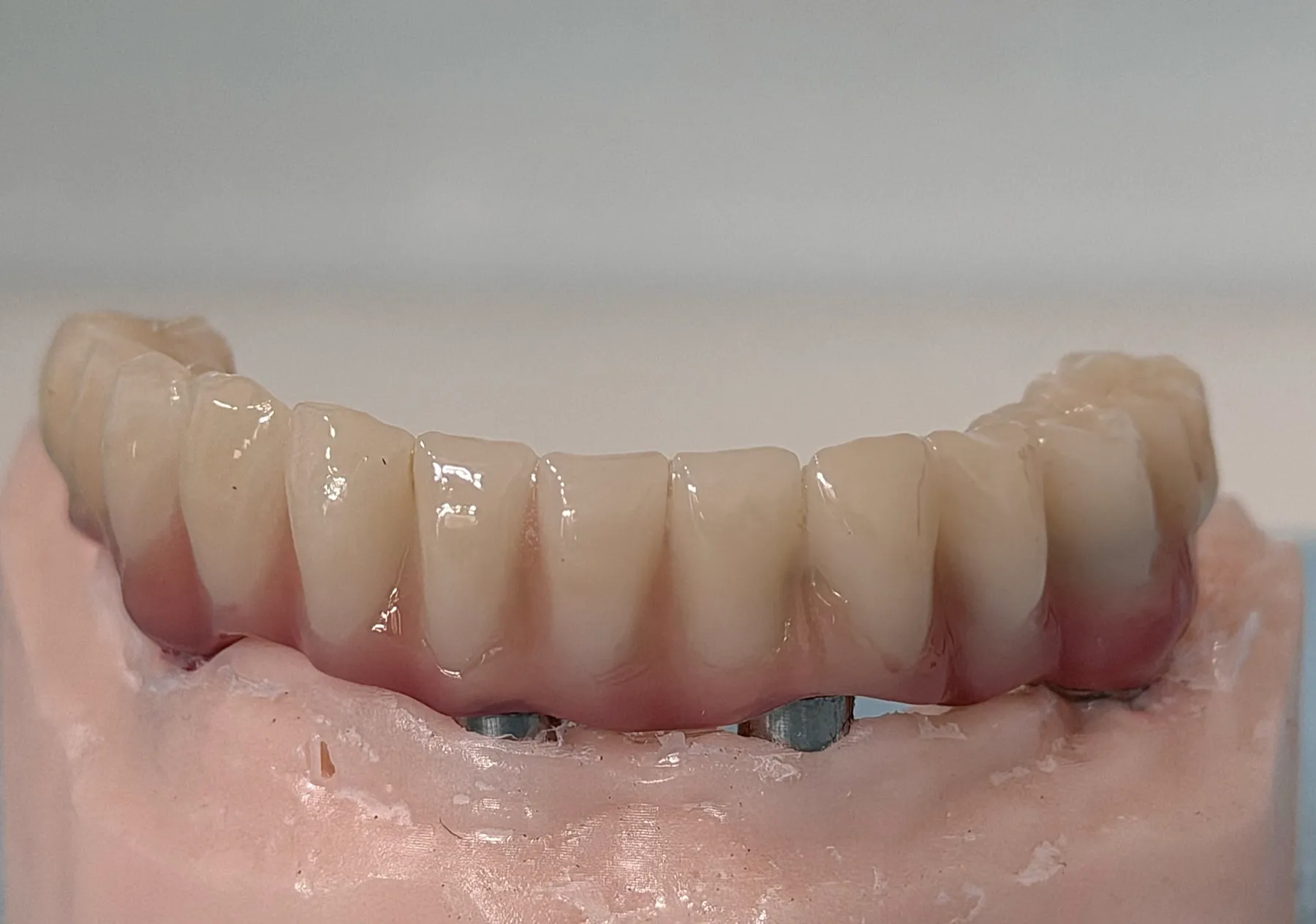 Full-Arch Fixed Implant Bridge