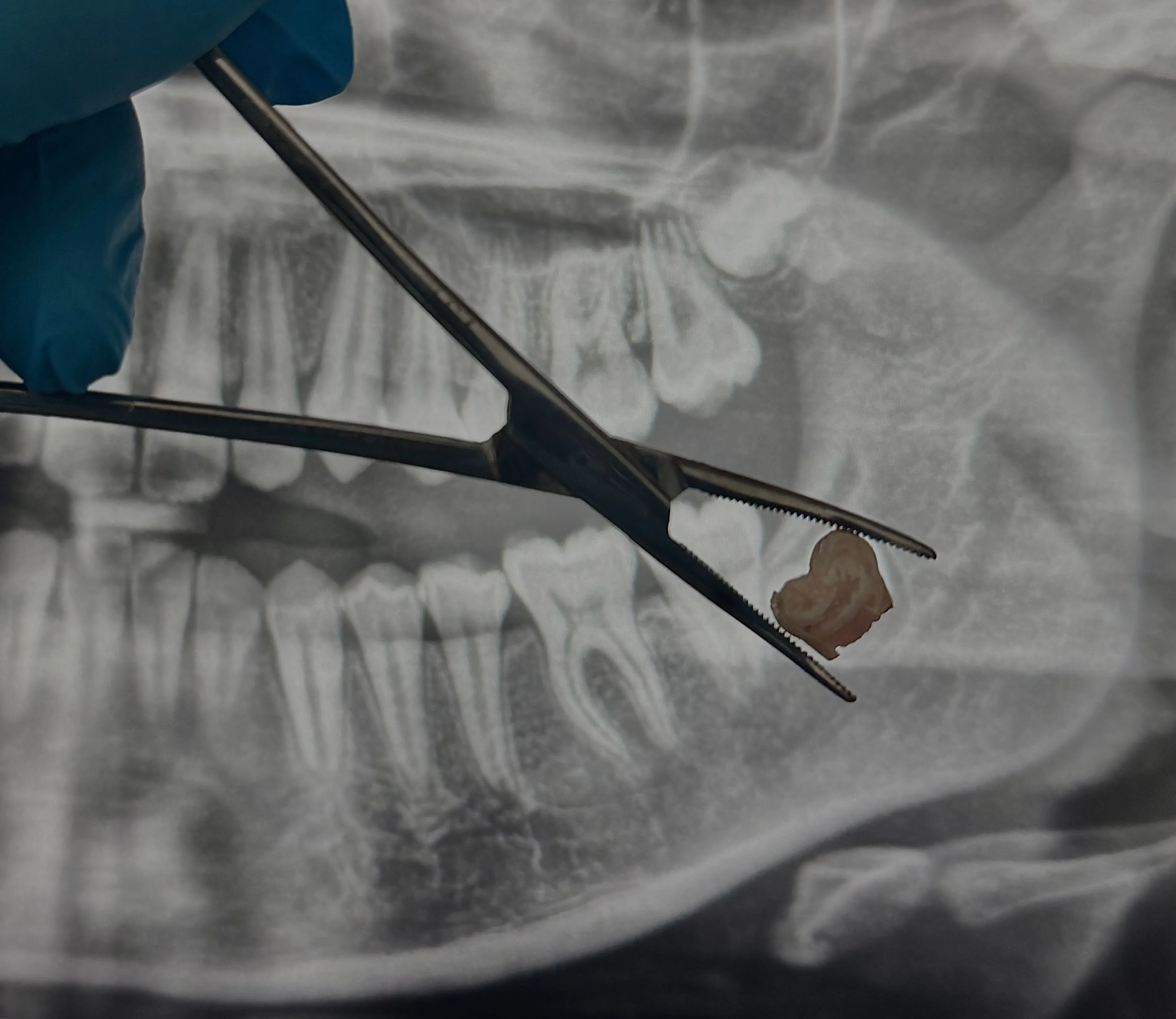 Germectomy for Orthodontic Treatment