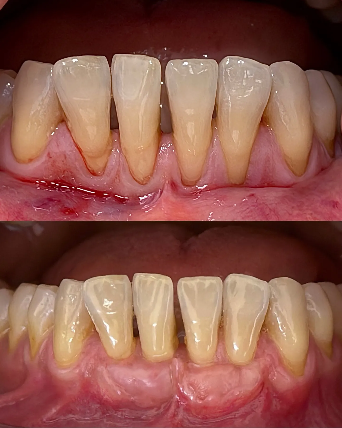 Gingival Recession Coverage