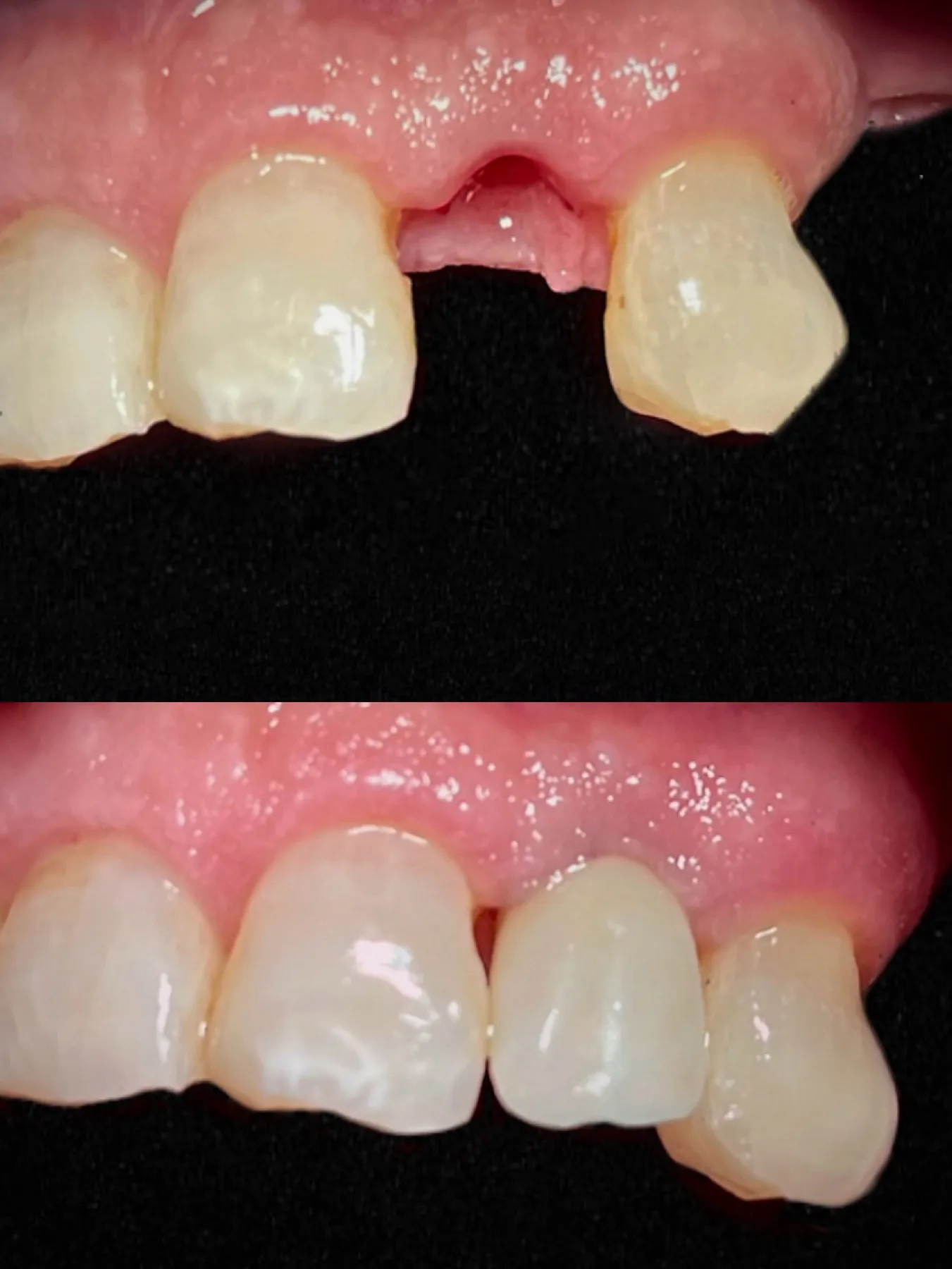 Immediate Implant with Immediate Loading, Lateral Incisor