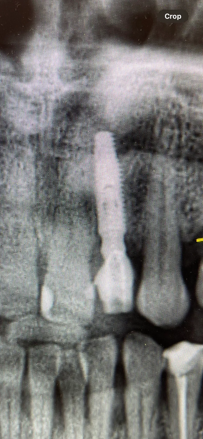 Immediate Implant with Immediate Loading, Lateral Incisor