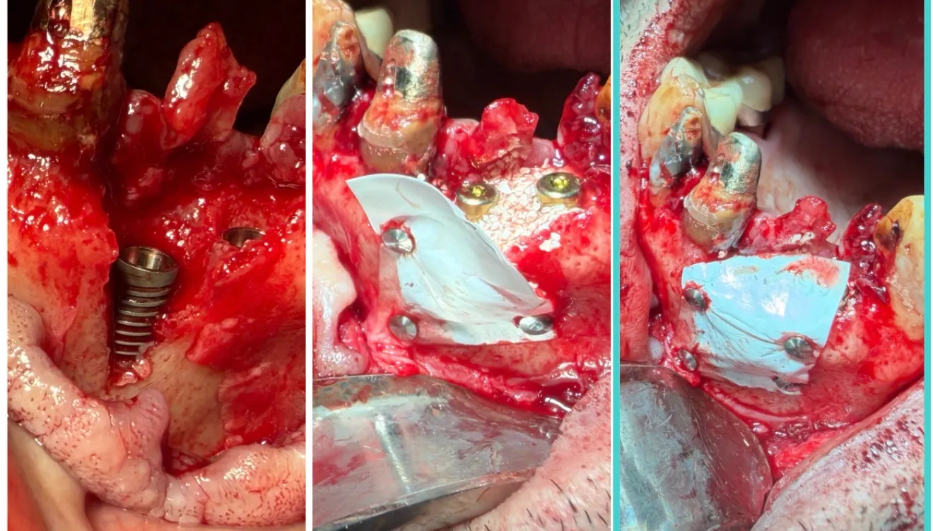 Immediate Implants with Guided Bone Regeneration, Teeth 11–12