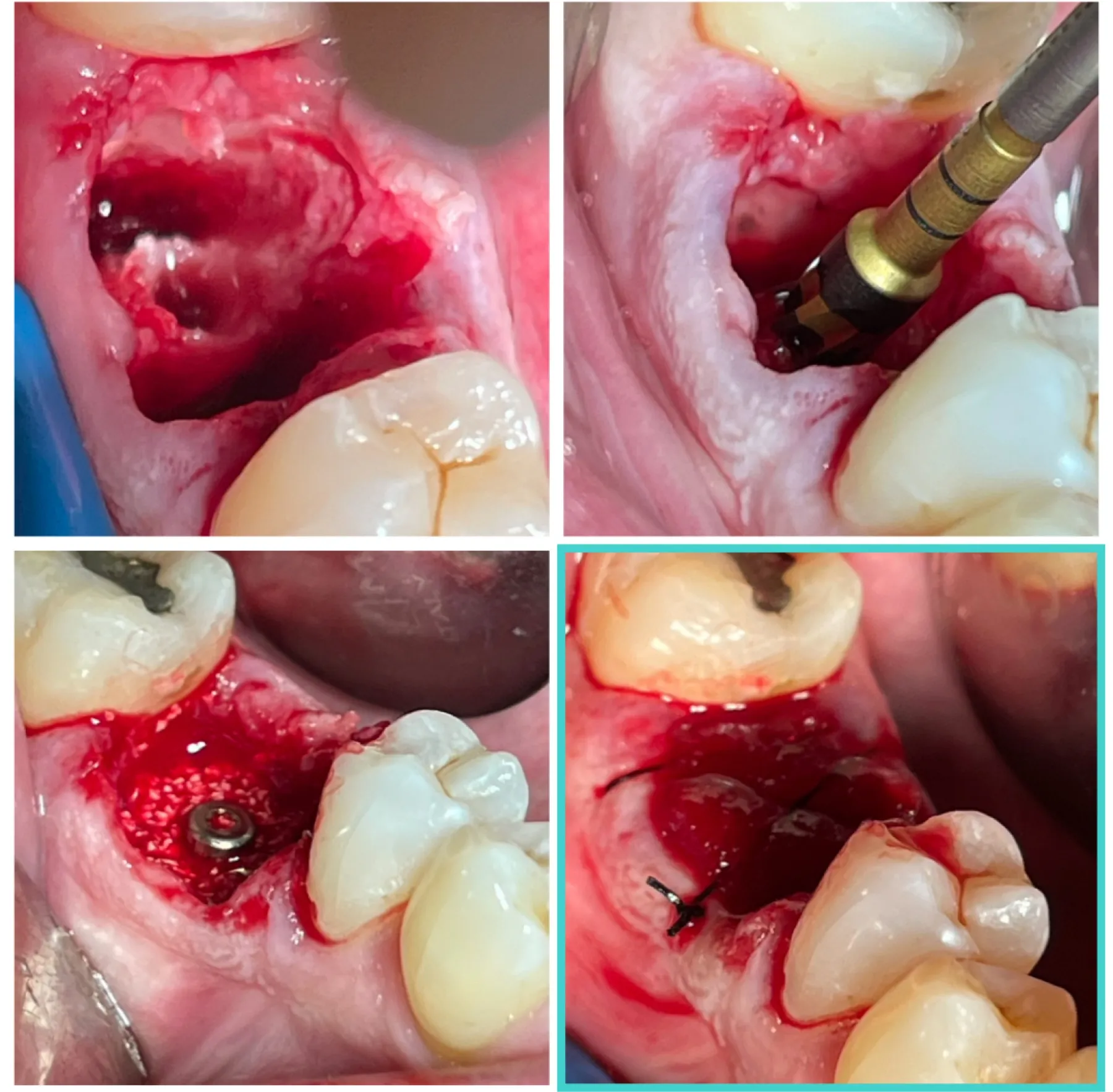 Immediate Molar Implant with Osteodensification