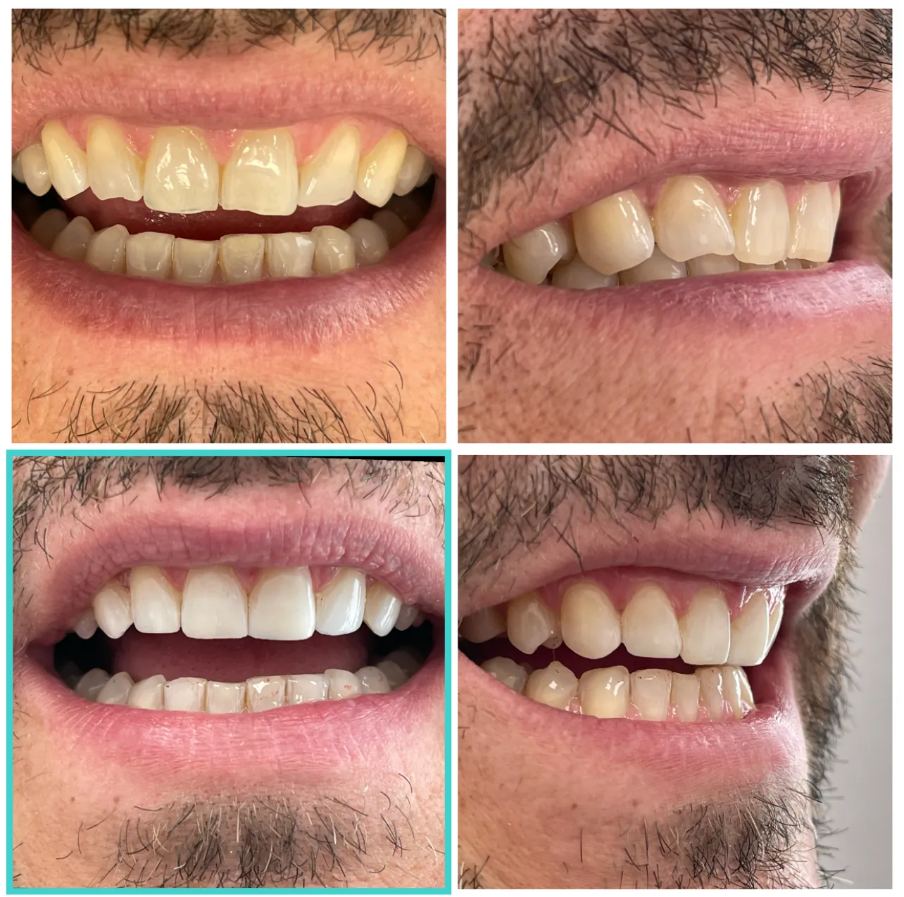 Injected Composite Veneers, Upper Front Six