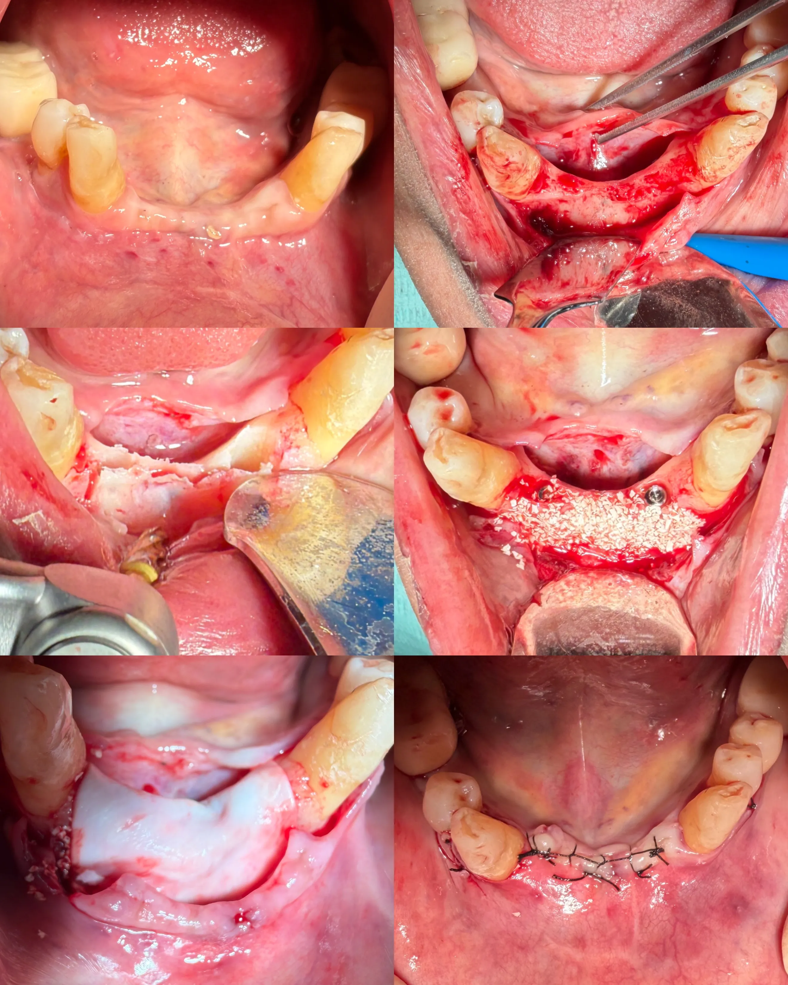 Mandibular Ridge Split with Simultaneous Implant Placement