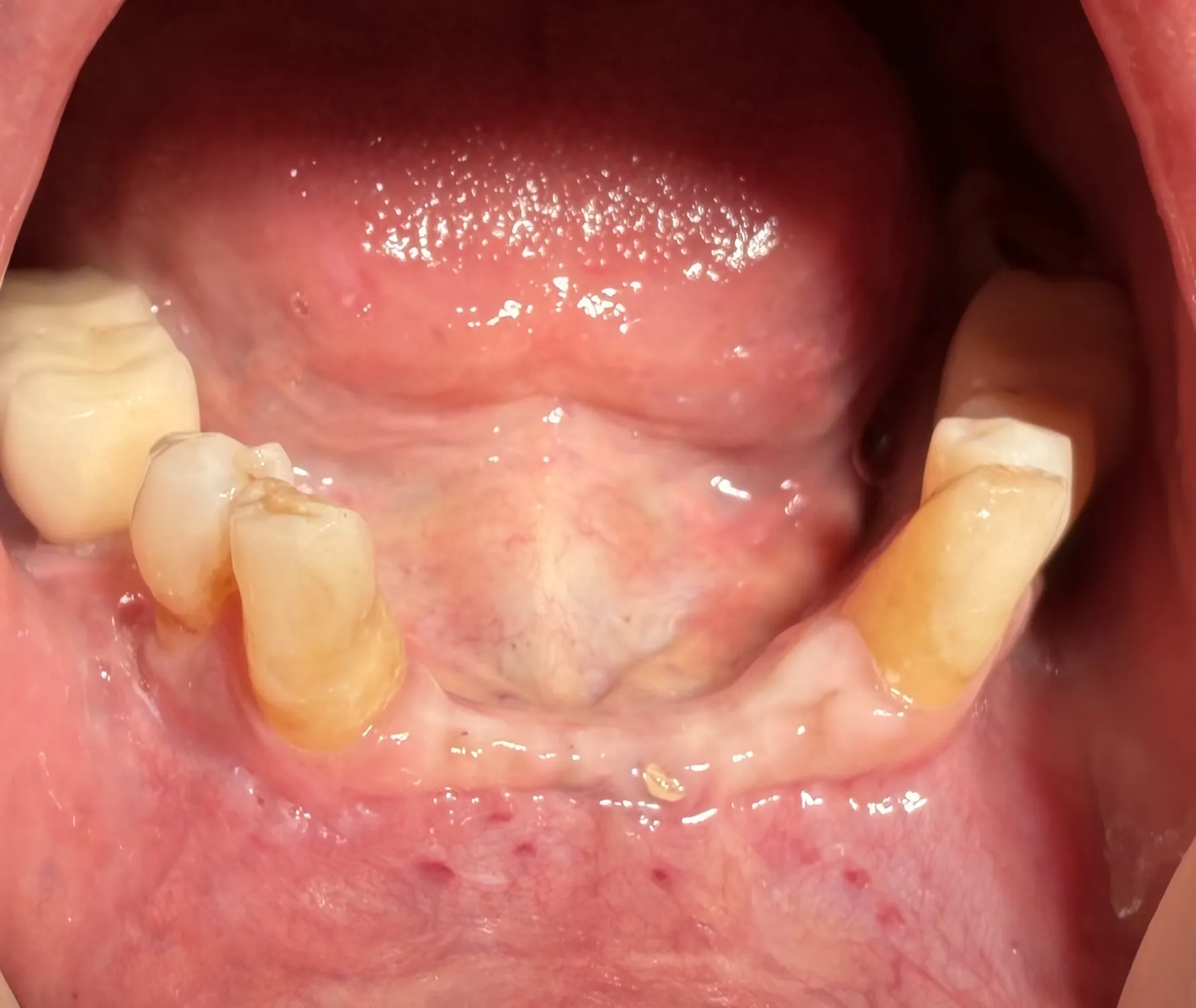 Mandibular Ridge Split with Simultaneous Implant Placement