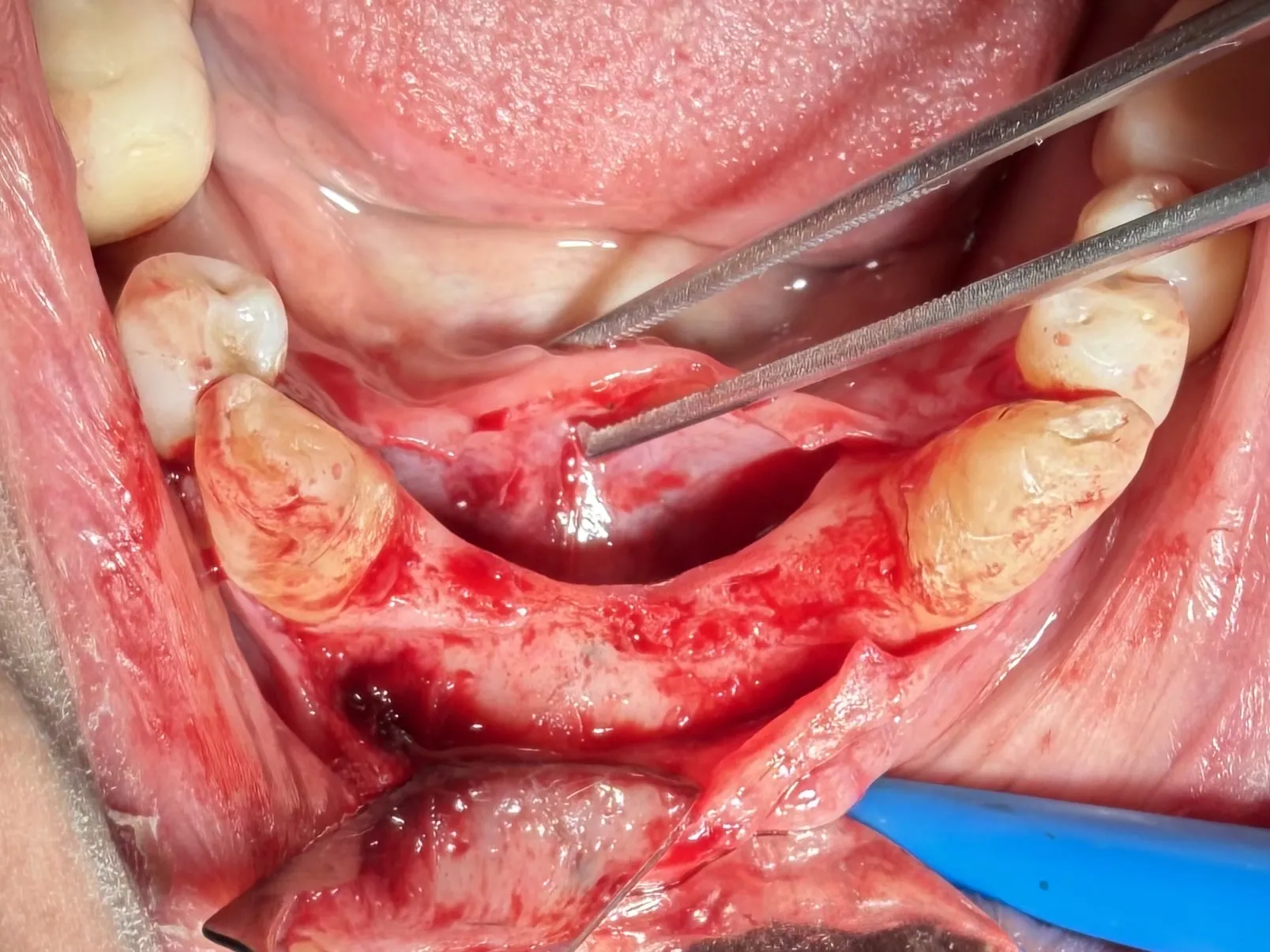 Mandibular Ridge Split with Simultaneous Implant Placement