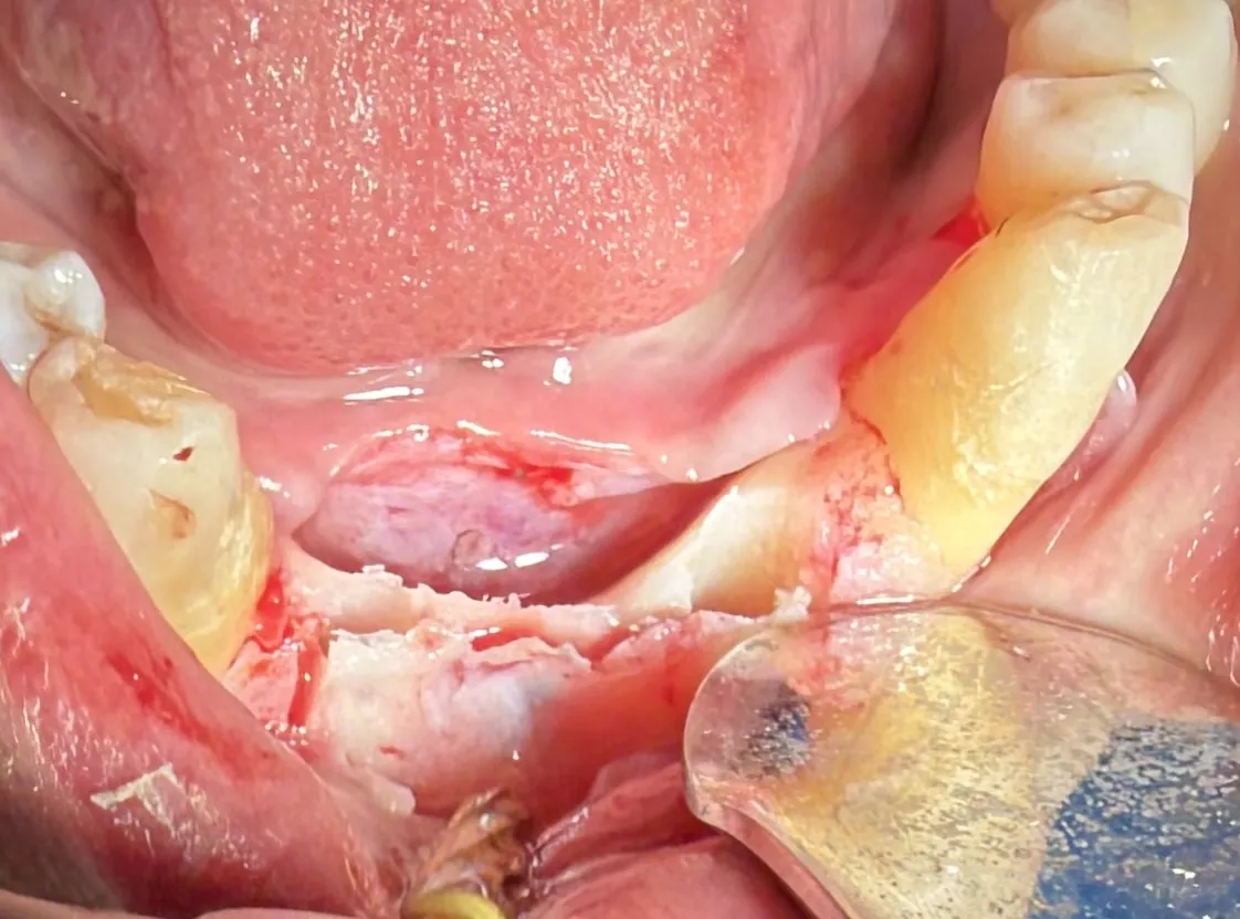 Mandibular Ridge Split with Simultaneous Implant Placement
