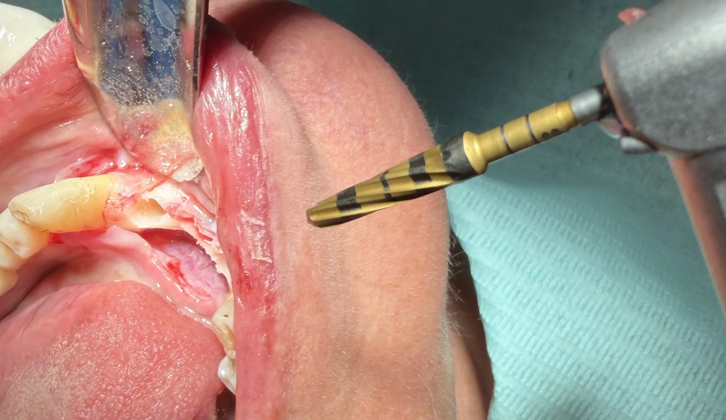 Mandibular Ridge Split with Simultaneous Implant Placement
