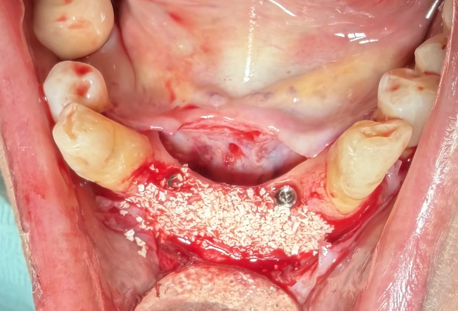 Mandibular Ridge Split with Simultaneous Implant Placement