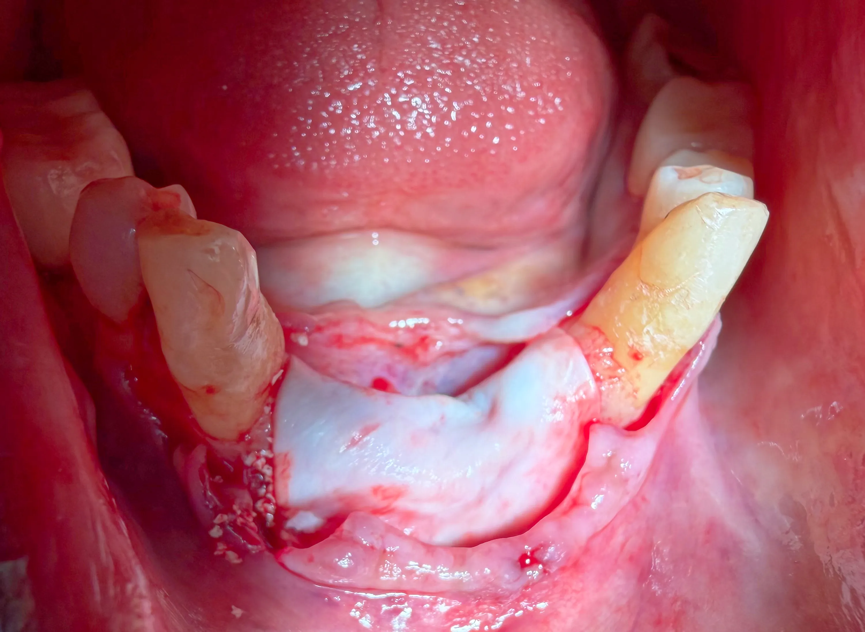 Mandibular Ridge Split with Simultaneous Implant Placement