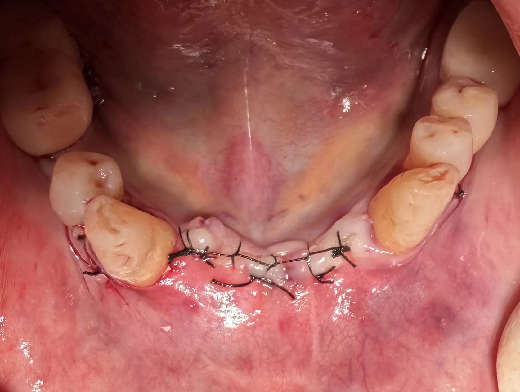 Mandibular Ridge Split with Simultaneous Implant Placement