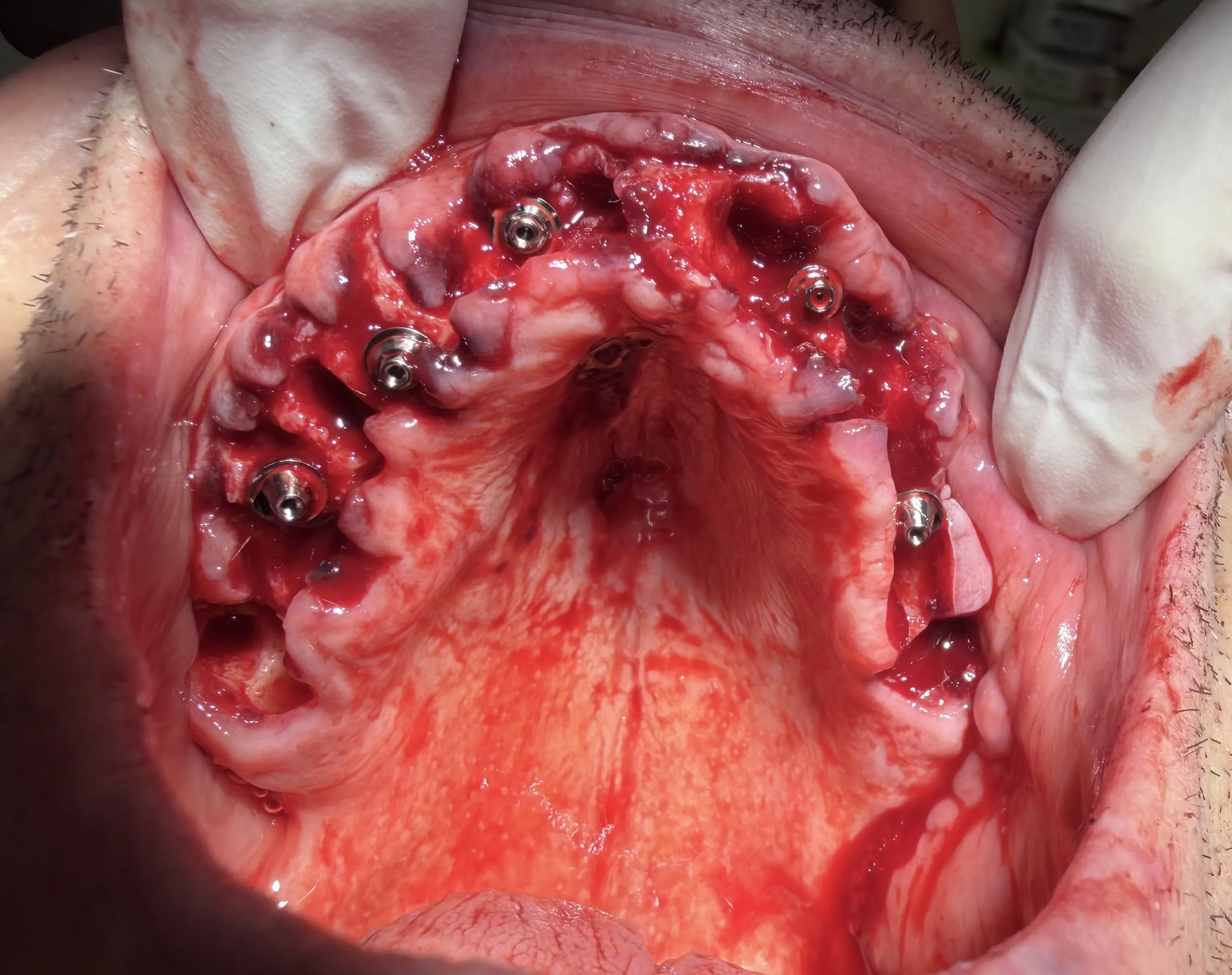 Maxillary All-on-X with Immediate Loading