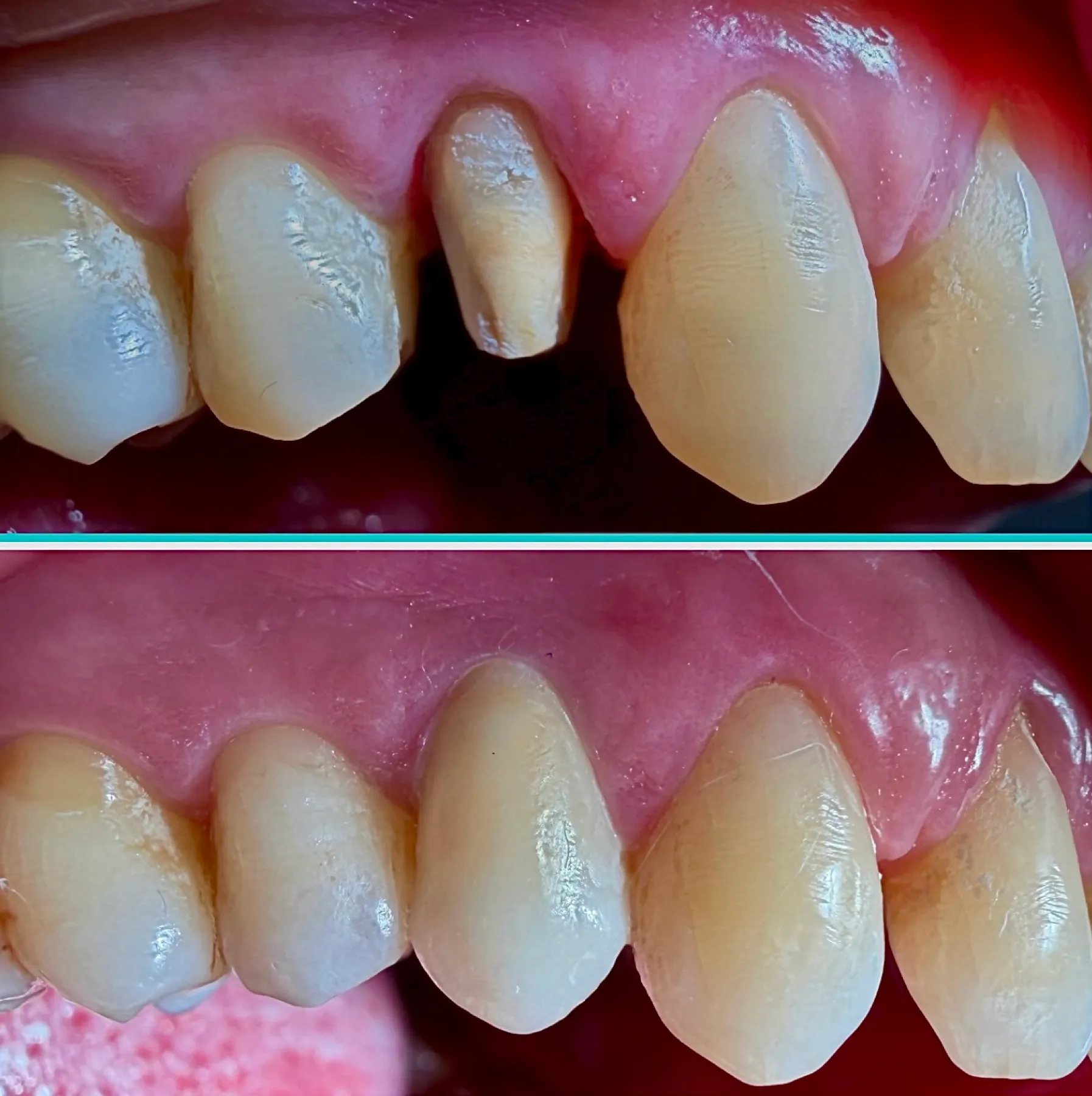 Premolar Crown with the BOPT Technique