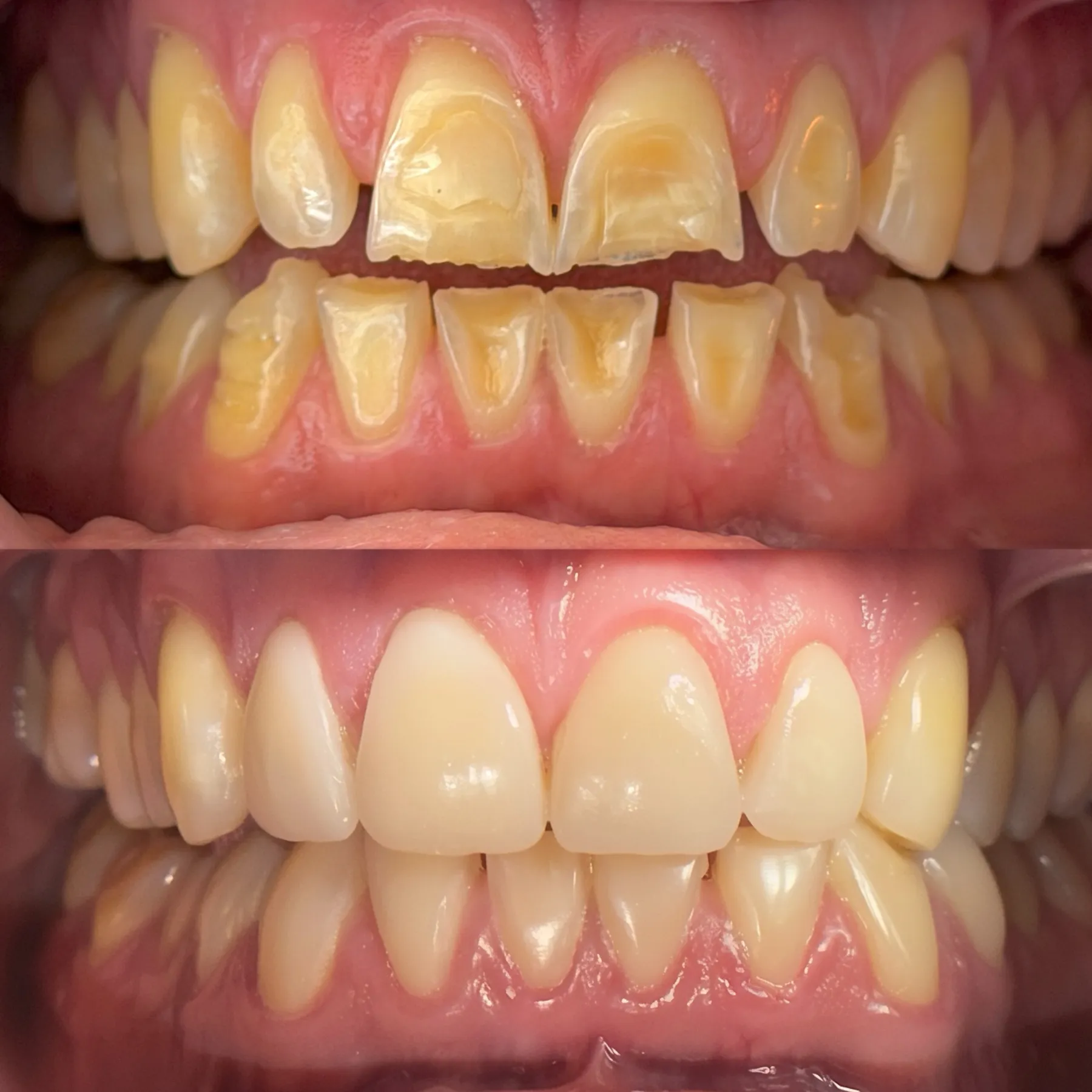 Rehabilitation of a Worn Dentition