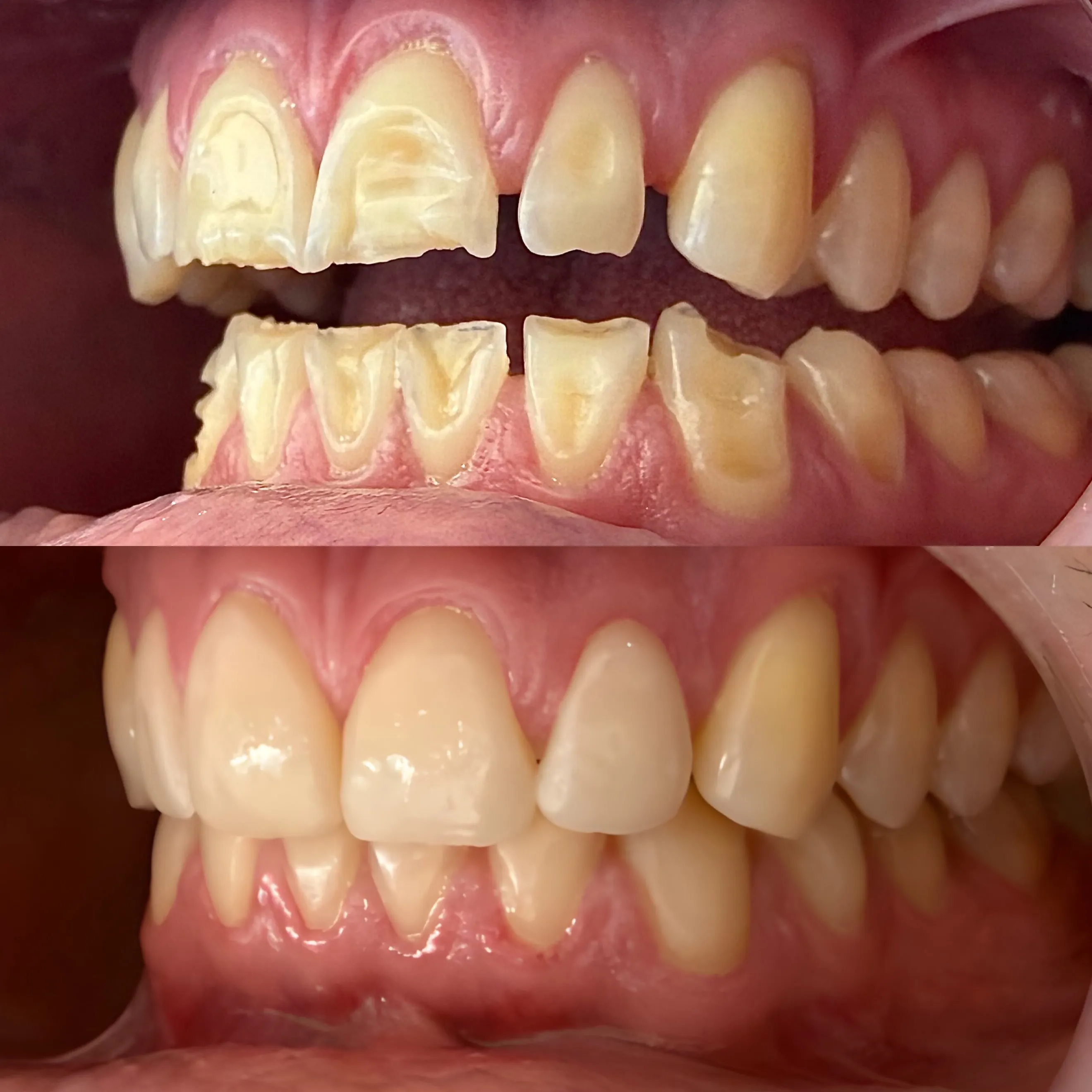 Rehabilitation of a Worn Dentition
