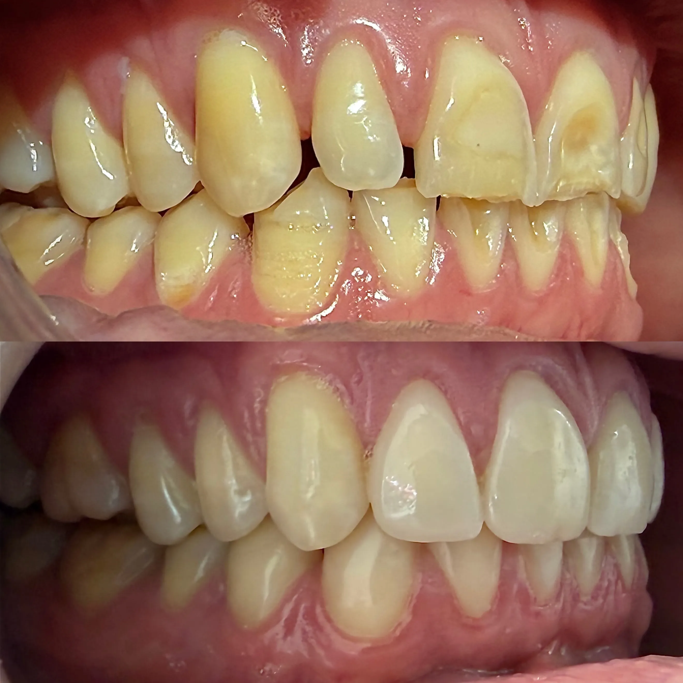 Rehabilitation of a Worn Dentition