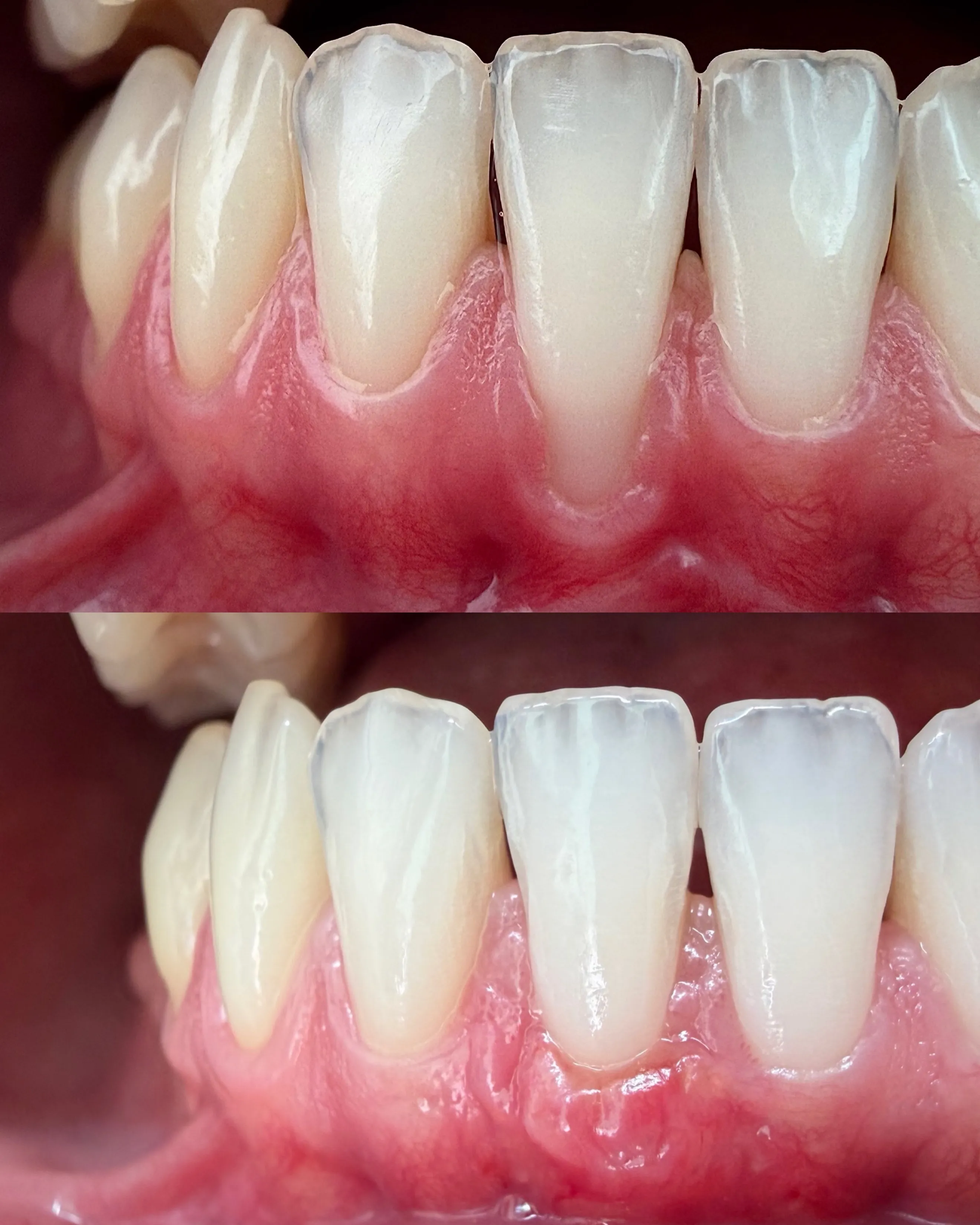 Single-Tooth Gingival Recession Coverage