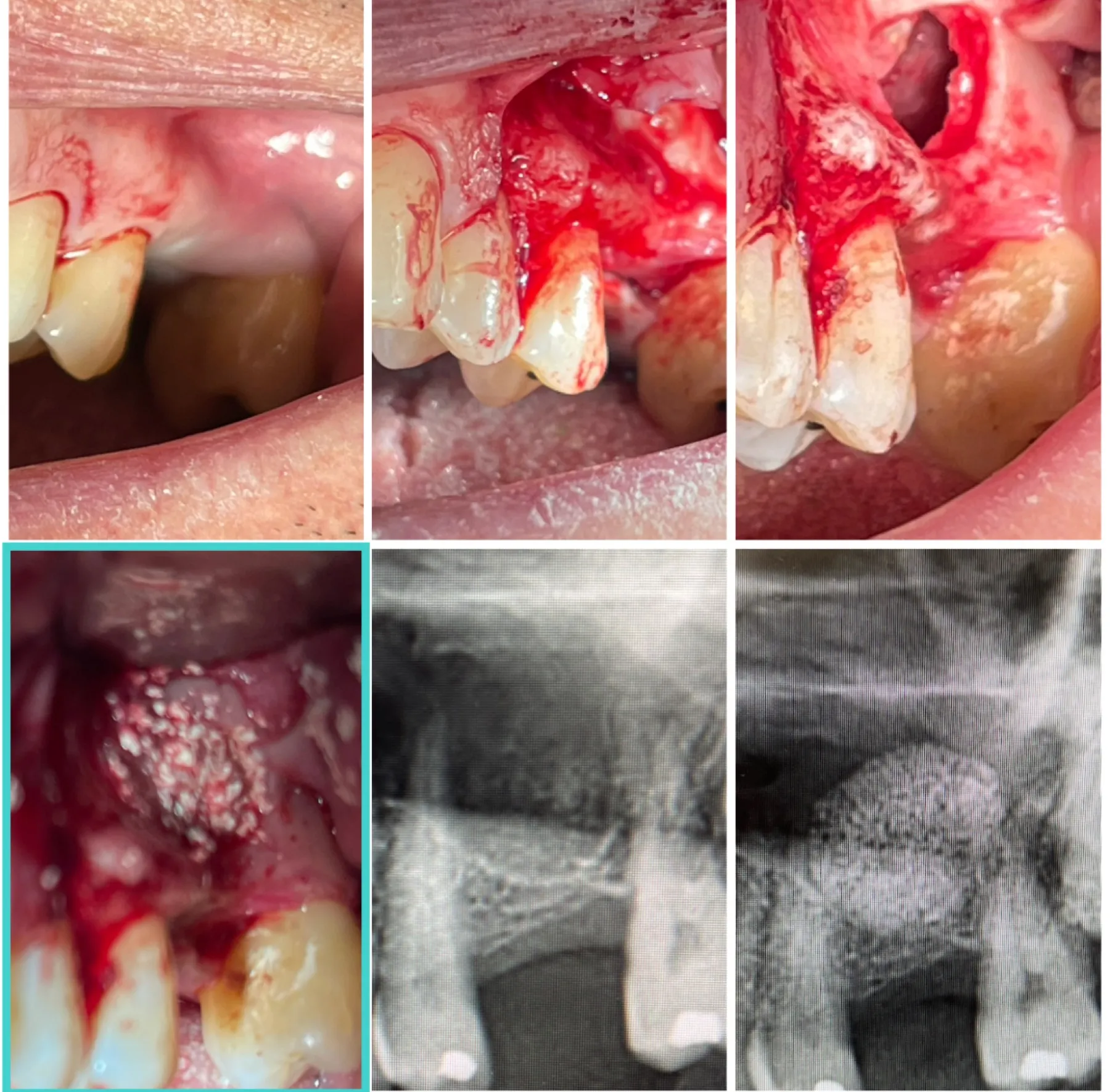 Staged Sinus Lift & Bone Regeneration
