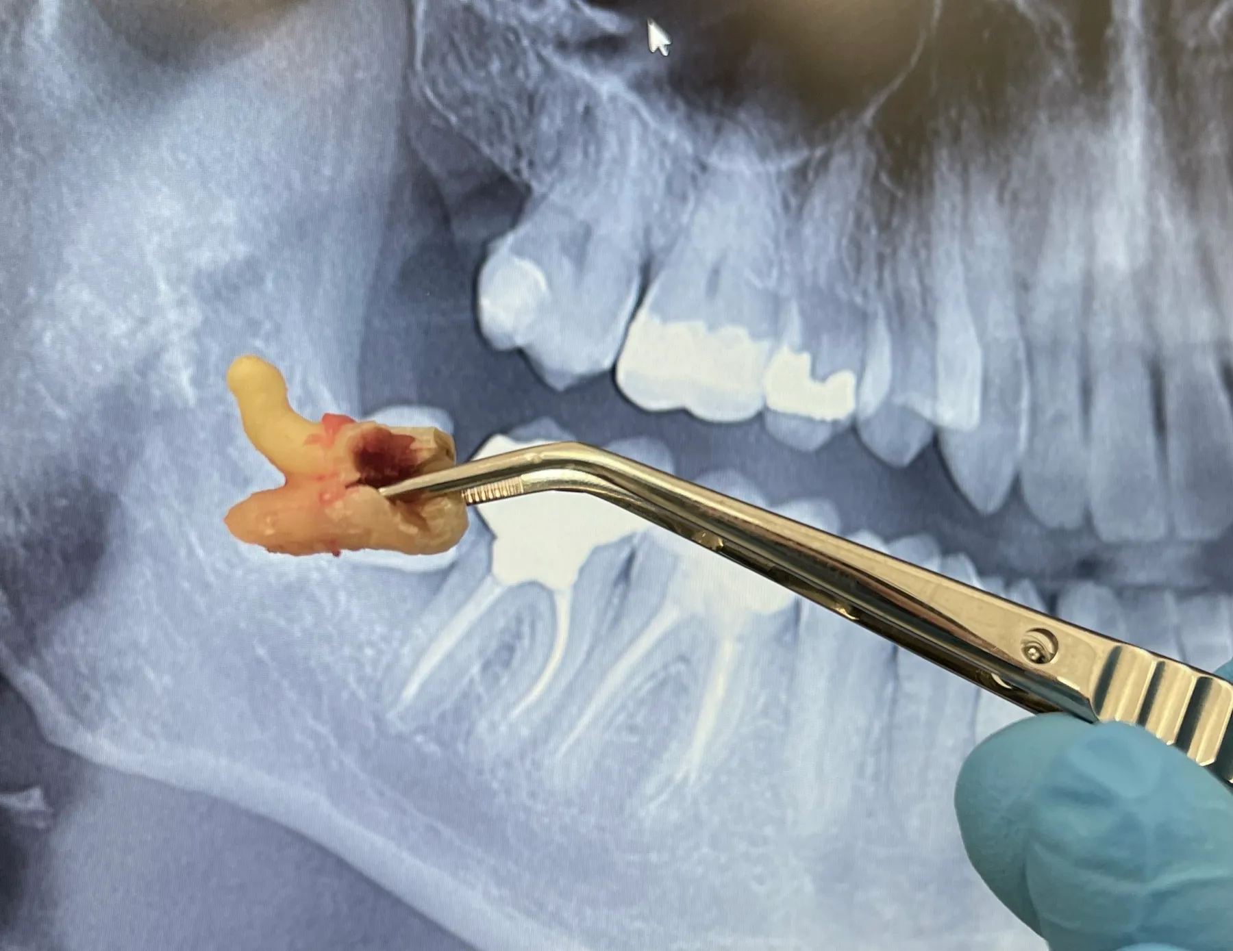 Surgical Extraction of a Compromised Molar
