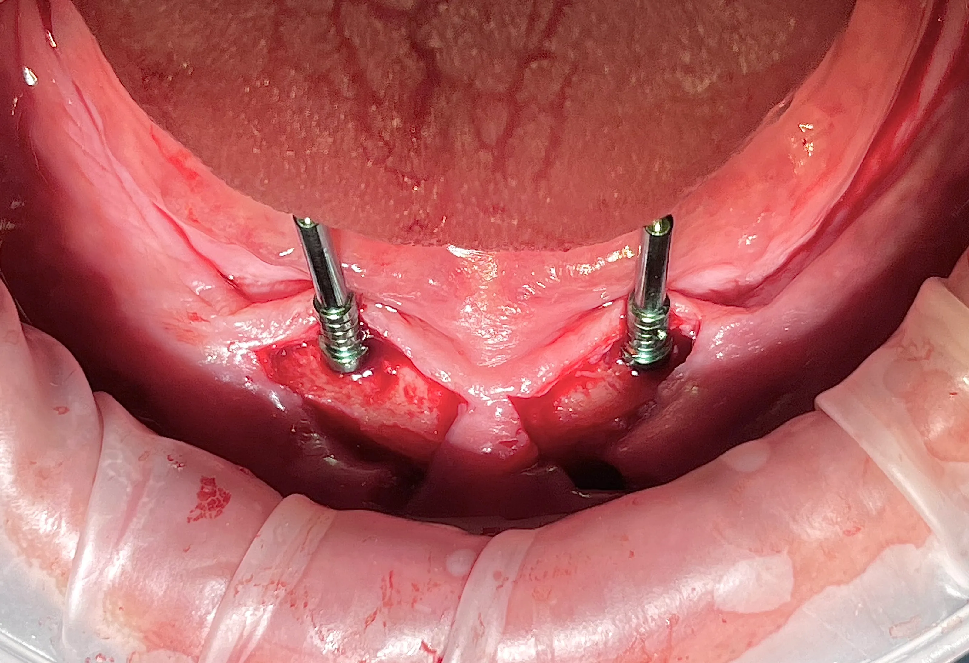 Two Implants for a Lower Overdenture